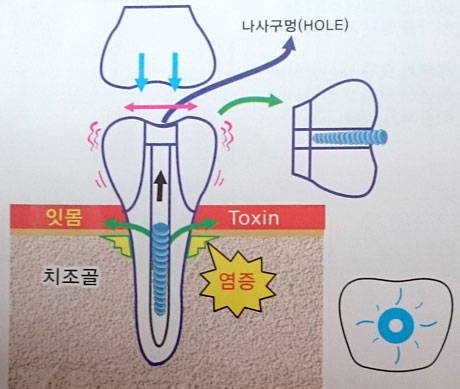 임플란트